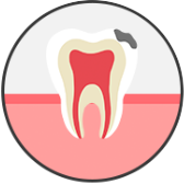 충치 초기 단계