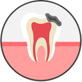 충치 중기 단계