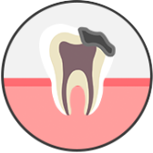 충치 말기 단계